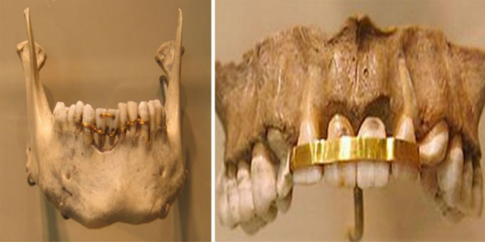 egypt-gold-plate-teeth